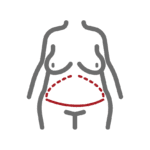 Extended Tummy Tuck Incision