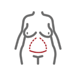 Standard Tummy Tuck Incision