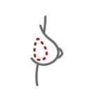 Displacement of an implant
