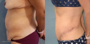 Abdominoplasty Before and After Photos Patient 13B