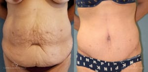 Abdominoplasty Before and After Photos Patient 13C