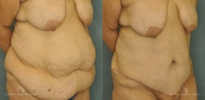 Abdominoplasty Before and After Patient 1B