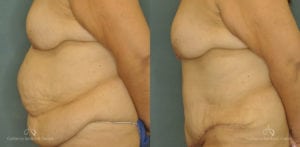 Abdominoplasty Before and After Patient 1C