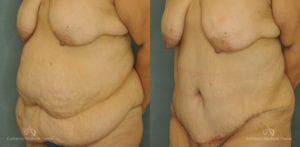 Abdominoplasty Before and After Patient 1D