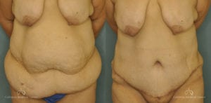 Abdominoplasty Before and After Patient 1E