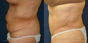 Abdominoplasty Before and After Photos Patient 2A