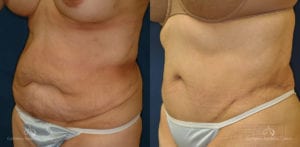 Abdominoplasty Before and After Photos Patient 2B
