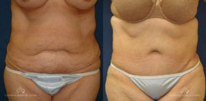 Abdominoplasty Before and After Photos Patient 2C