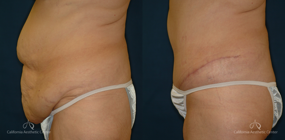 Abdominoplasty Before and After Photos Patient 3A