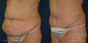 Abdominoplasty Before and After Photos Patient 3B