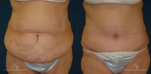 Abdominoplasty Before and After Photos Patient 3C