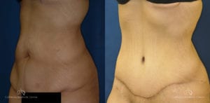 Abdominoplasty Before and After Photos Patient 4B