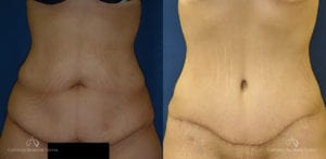 Abdominoplasty Before and After Photos Patient 4C