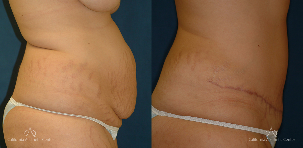 Abdominoplasty Before and After Photos Patient 5A