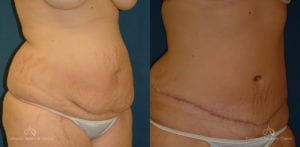 Abdominoplasty Before and After Photos Patient 5B