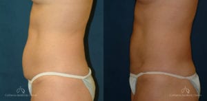Abdominoplasty Before and After Photos Patient 6A