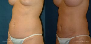 Abdominoplasty Before and After Photos Patient 6B