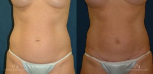Abdominoplasty Before and After Photos Patient 6C