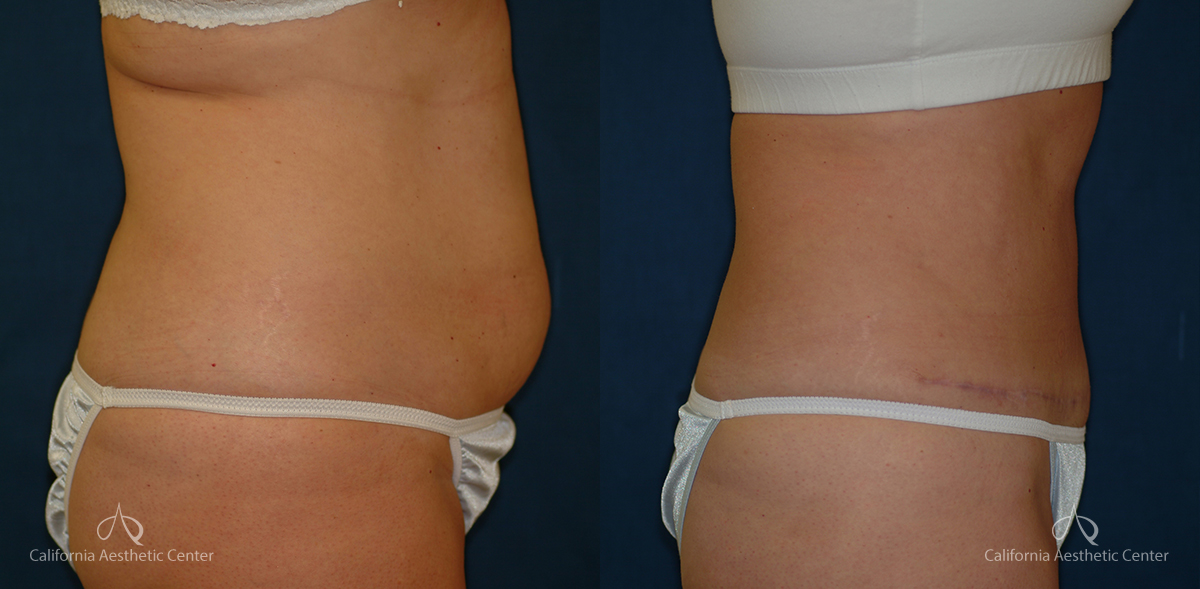 Abdominoplasty Before and After Photos Patient 7A