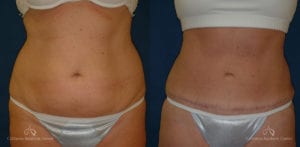 Abdominoplasty Before and After Photos Patient 7C