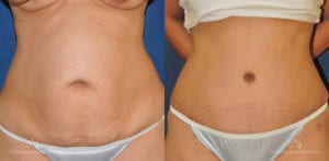 Abdominoplasty Before and After Photos Patient 8C