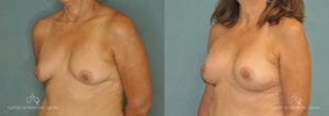 Breast Augmentation Before and After Patient 1D