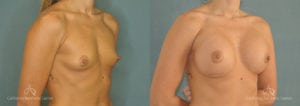 Breast Augmentation Before and After Patient 2B