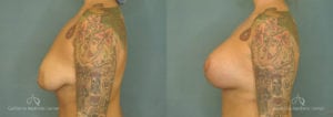 Breast Augmentation Before and After Patient 3C