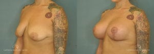 Breast Augmentation Before and After Patient 3D