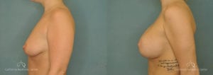 Breast Augmentation Before and After Patient 4C