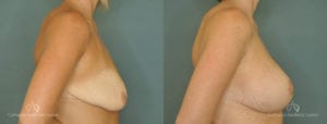 Breast Augmentation Before and After Patient 5A