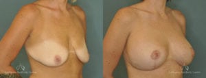 Breast Augmentation Before and After Patient 5B