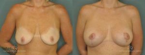 Breast Augmentation Before and After Patient 5E