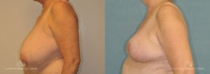 Breast Reduction Before and After Photos Patient 1C