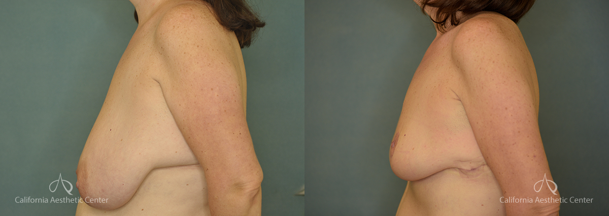 Breast Reduction Before and After Photos Patient 2A