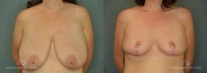 Breast Reduction Before and After Photos Patient 2C
