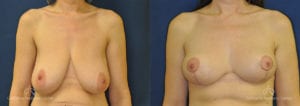 Breast Reduction Before and After Photos Patient 3C