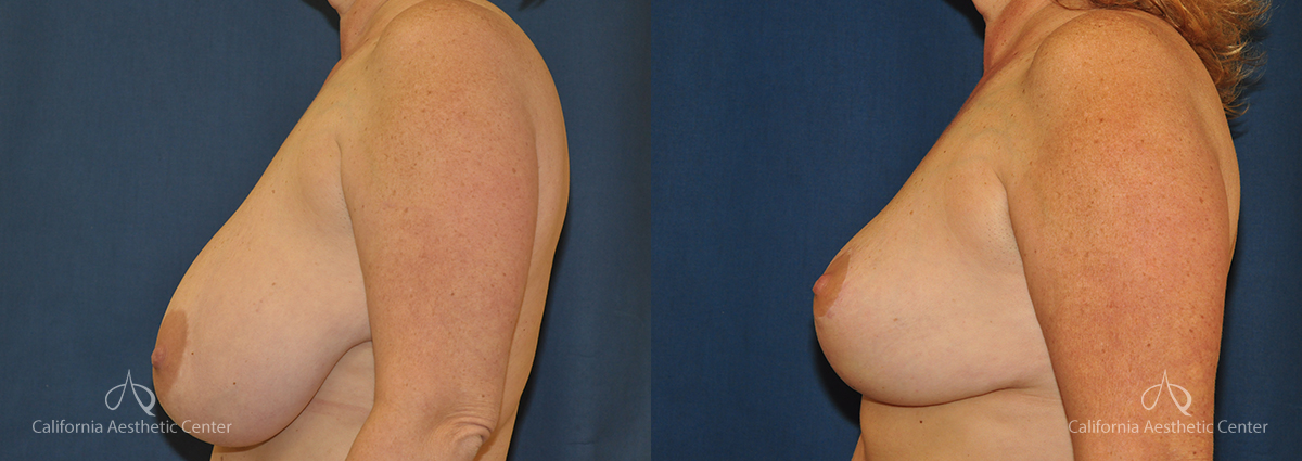 Breast Reduction Before and After Photos Patient 4A