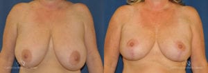 Breast Reduction Before and After Photos Patient 4C