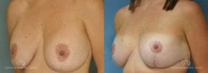 Breast Reduction Before and After Photos Patient 5B