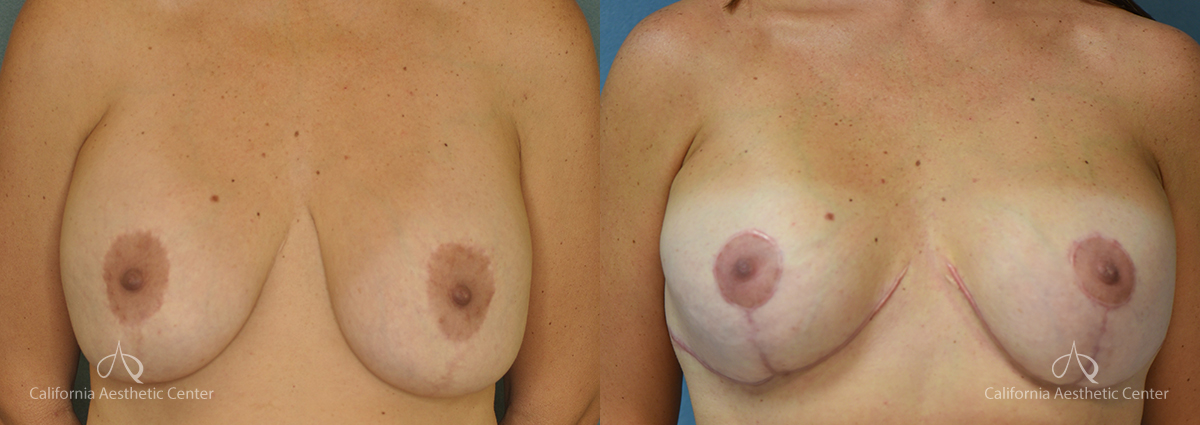 Breast Reduction Before and After Photos Patient 5C
