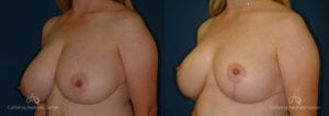 Breast Reduction Before and After Photos Patient 6B