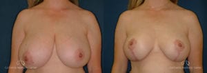 Breast Reduction Before and After Photos Patient 6C