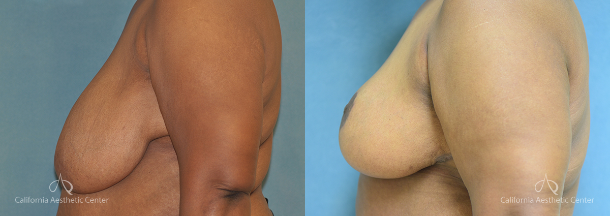 Breast Reduction Before and After Photos Patient 7A