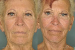Face Lift Before and After Photos Patient 1A