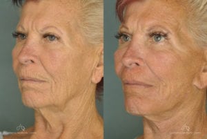 Face Lift Before and After Photos Patient 1B