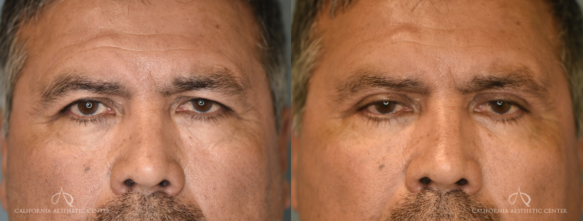 Patient 5 Blepharoplasty Before and After Front View