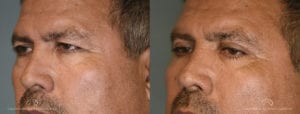 Patient 5 Blepharoplasty Before and After Left Oblique View