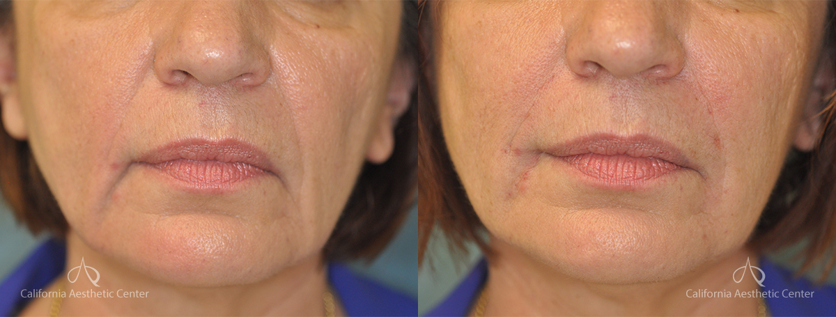 Juvederm Before and After Photos Patient 1