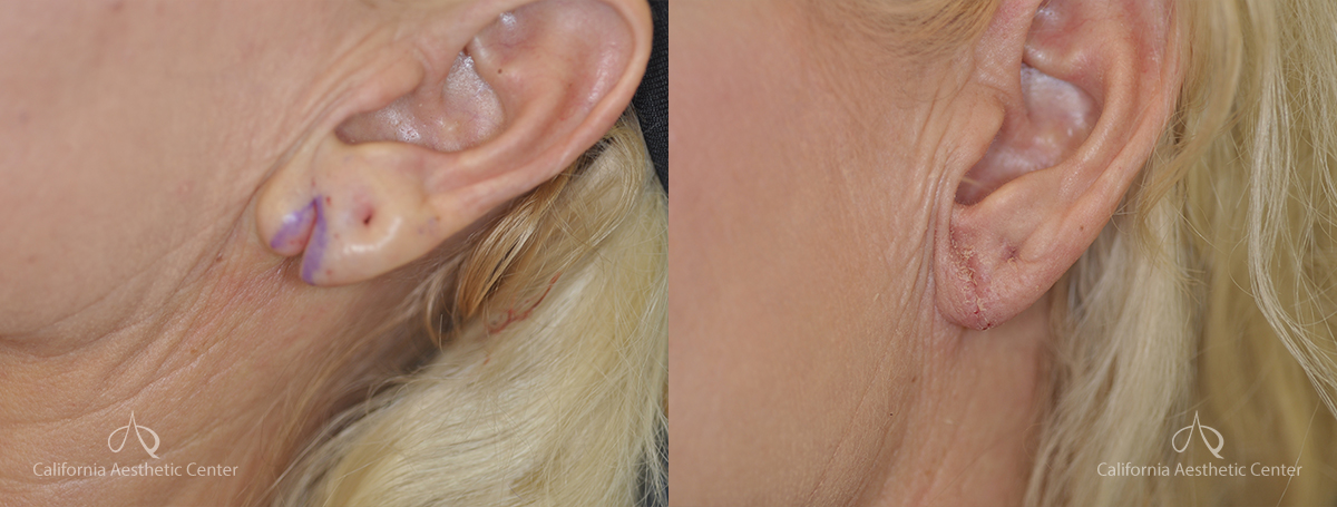 Earlobe Repair Before and After Photos Patient 1A
